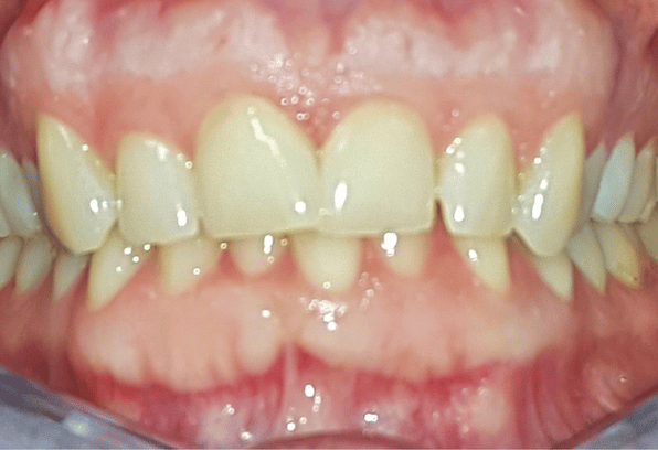 Before- Face - Stamford Dental Care