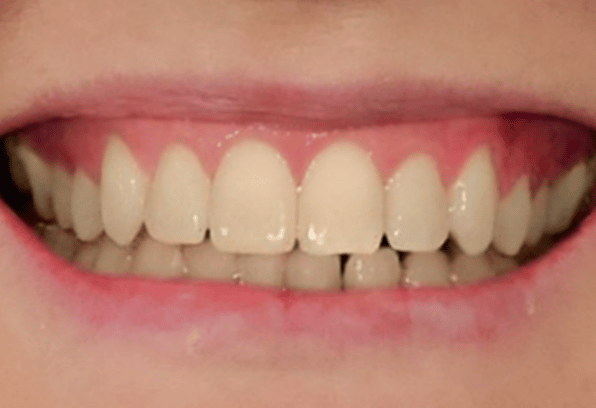 After Face - Stamford Dental Care